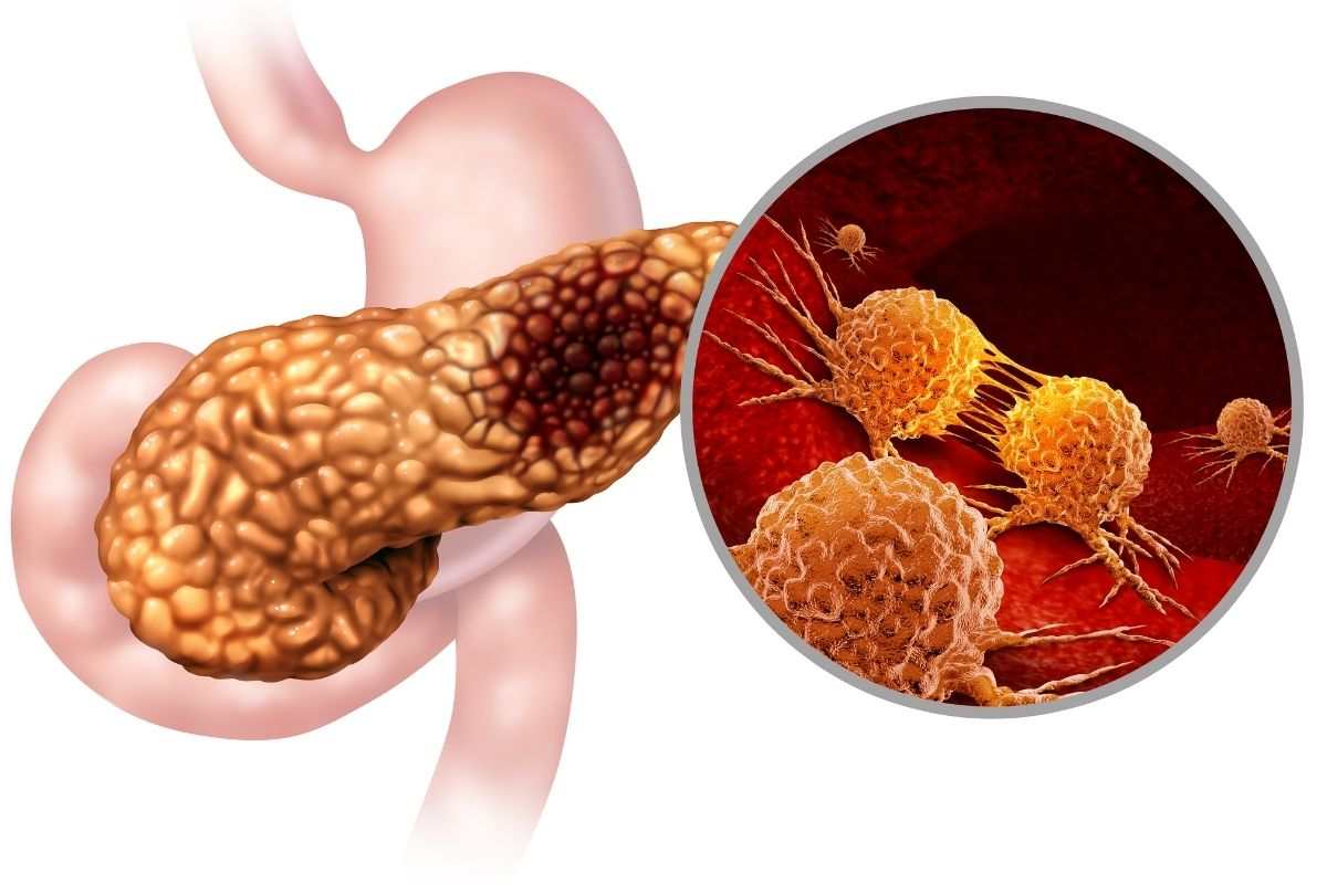 Cellule cancerogene nel pancreas
